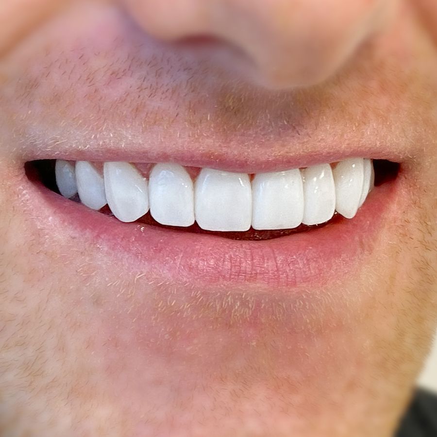 composite bonding - Kyle Dunphy - after - 3Dental